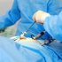 Хирургическое устранение сосудистых узлов в паху