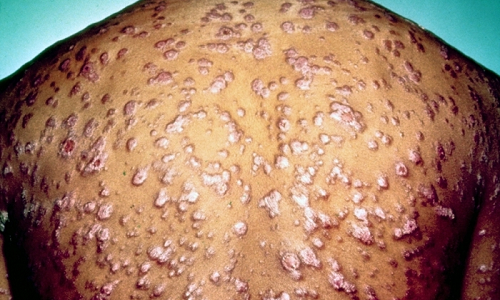 пустулезная форма сыпи при сифилисе