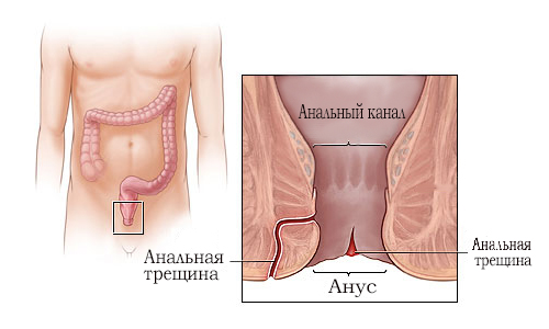 Anal'naja treshhina