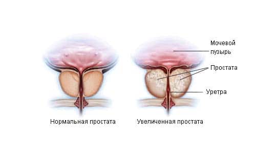 Здоровая и увеличенная простата