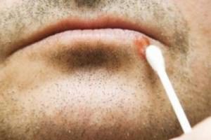 Герпес на губах у мужчин, причини и симптоми болезни, лечение